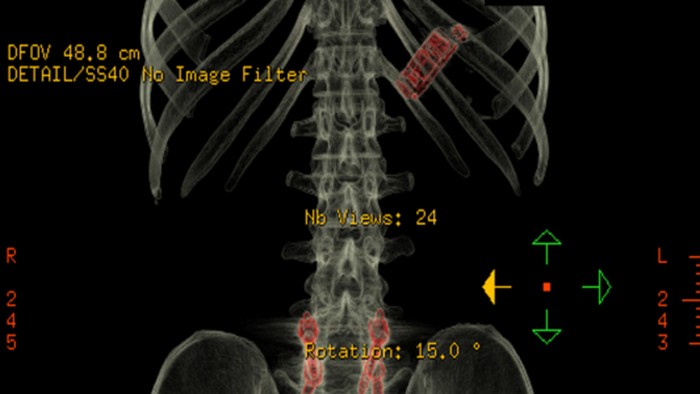 Penampakan ponsel dalam tubuh manusia.