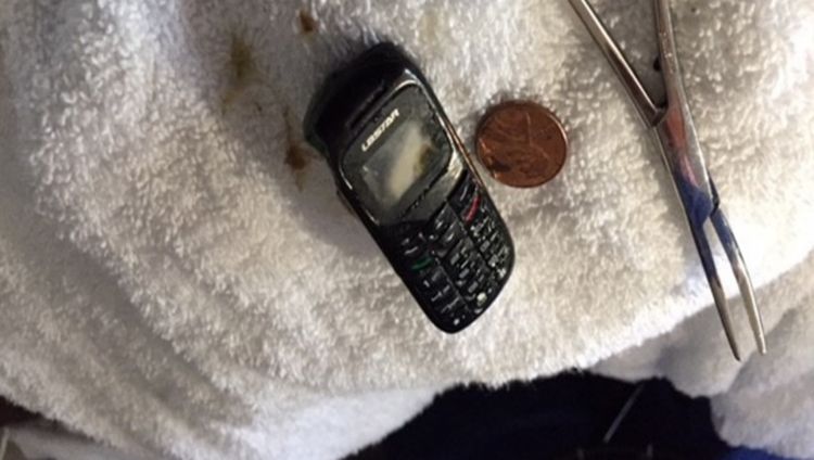 Foto: Dokter Angkat HP yang Nyangkut di Perut Pasien, Penampakannya Bikin Ngilu