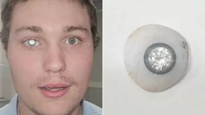 Slater Jones, desainer perhiasan pasang berlian di mata palsu.