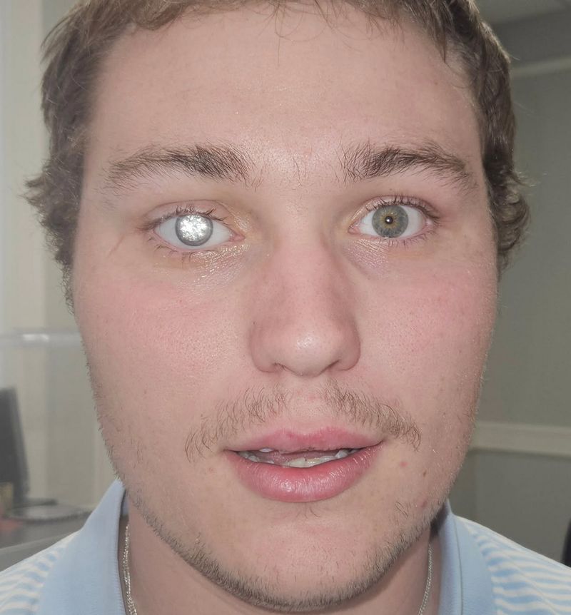 Slater Jones Slater Jones, desainer perhiasan pasang berlian di mata palsu.