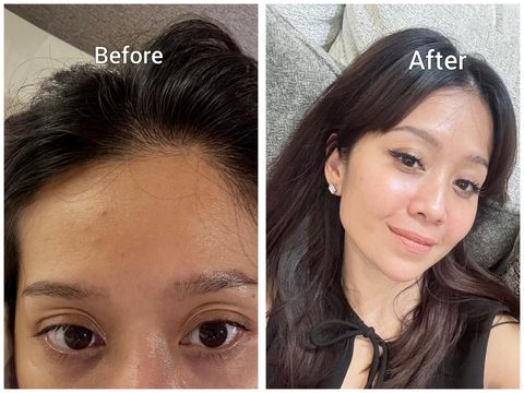 Treatment jet peel, laser rejuve, peeling retinol Treatment jet peel, laser rejuve, peeling retinol