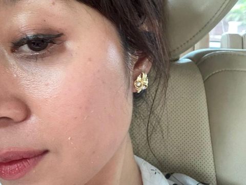 Treatment jet peel, laser rejuve, peeling retinol Treatment jet peel, laser rejuve, peeling retinol