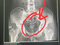 Sembunyikan Sabu dalam Dubur, Pria Ditangkap di Bandara Hang Nadim Batam