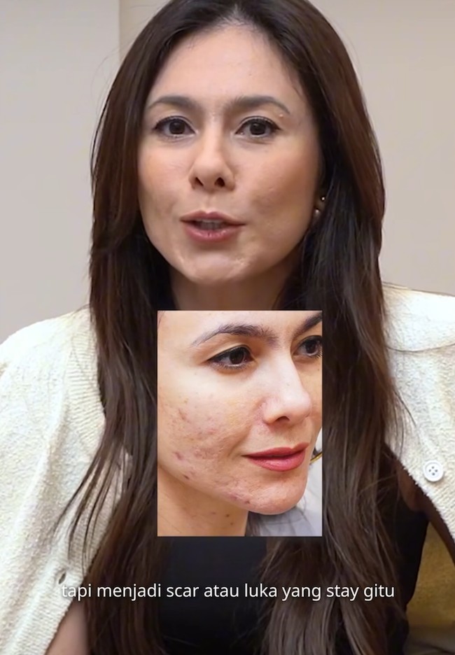 Memiliki wajah sensitif yang kerap timbul jerawat membuat Wulan memiliki permasalahan kulit kemerahan hingga bopeng. Ia pun mengaku selalu harus mengenakan makeup saat keluar rumah agar lebih percaya diri. Foto: ZAP Premier