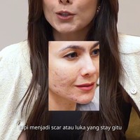Memiliki wajah sensitif yang kerap timbul jerawat membuat Wulan memiliki permasalahan kulit kemerahan hingga bopeng. Ia pun mengaku selalu harus mengenakan makeup saat keluar rumah agar lebih percaya diri. Foto: ZAP Premier