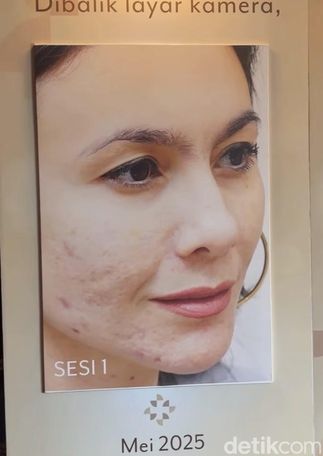 Meski sempat pasrah dengan kondisi kulitnya tersebut, kini wanita 44 tahun itu akhirnya kembali bersemangat melakukan perawatan untuk memperbaiki kondis wajahnya. Wulan pun mengaku wajahnya kini sudah jauh lebih baik dan sehat dibanding sebelumnya. Foto: Vina Oktiani/Wolipop