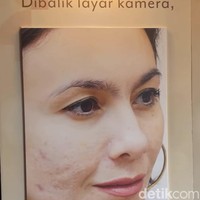 Meski sempat pasrah dengan kondisi kulitnya tersebut, kini wanita 44 tahun itu akhirnya kembali bersemangat melakukan perawatan untuk memperbaiki kondis wajahnya. Wulan pun mengaku wajahnya kini sudah jauh lebih baik dan sehat dibanding sebelumnya. Foto: Vina Oktiani/Wolipop