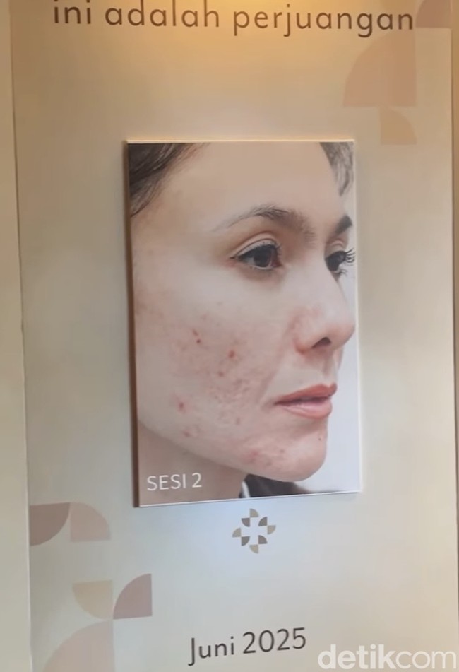 Kini Wulan menjalani beragam perawatan khusus untuk mengembalikan tekstur wajahnya. Yang dilakukan macam-macam ya, dari yang sifatnya laser, suntikan, subsisi, sampai tetes-tetes kimia. Jadi sekali treatment itu aku bisa kombinasi 3–4 perawatan. Itu mungkin hasil rembukan dokter, melihat kondisi kulitku yang udah lama berjuang, jadi dibutuhkan treatment yang macam-macam dicampur jadi satu,” jelas Wulan. Foto: Vina Oktiani/Wolipop