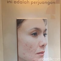 Kini Wulan menjalani beragam perawatan khusus untuk mengembalikan tekstur wajahnya. Yang dilakukan macam-macam ya, dari yang sifatnya laser, suntikan, subsisi, sampai tetes-tetes kimia. Jadi sekali treatment itu aku bisa kombinasi 3–4 perawatan. Itu mungkin hasil rembukan dokter, melihat kondisi kulitku yang udah lama berjuang, jadi dibutuhkan treatment yang macam-macam dicampur jadi satu,” jelas Wulan. Foto: Vina Oktiani/Wolipop