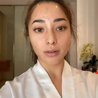 Nikita Willy sempat membagikan wajahnya saat sedang berjerawat parah. Tetap percaya diri, ia mengunggah fotonya tersebut ke Instagram dan membagikan proses penyembuhan jerawatnya hingga kembali mulus. Foto: Instagram