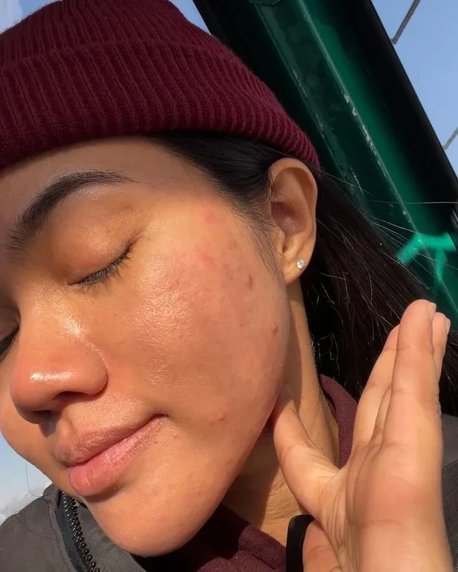 Penyanyi Yura Yunita sempat memamerkan wajah aslinya yang tak mulus. Dihiasi dengan jerawat dan bekas-bekasnya, Yura selalu memberikan pesan postif untuk mencintai diri sendiri di balik unggahannya. Foto: Instagram