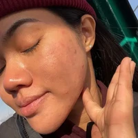 Penyanyi Yura Yunita sempat memamerkan wajah aslinya yang tak mulus. Dihiasi dengan jerawat dan bekas-bekasnya, Yura selalu memberikan pesan postif untuk mencintai diri sendiri di balik unggahannya. Foto: Instagram