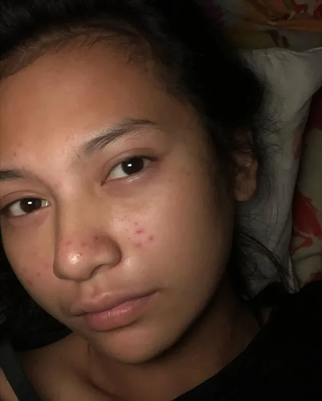 Indah Permatasari juga pernah mengakui bahwa dirinya mengalami masalah jerawat. Sebagai buktinya, ia memamerkan wajahnya saat sedang jerawatan. Beruntungnya kini wajah Indah sudah kembali mulus. Foto: Instagram