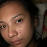 Indah Permatasari juga pernah mengakui bahwa dirinya mengalami masalah jerawat. Sebagai buktinya, ia memamerkan wajahnya saat sedang jerawatan. Beruntungnya kini wajah Indah sudah kembali mulus. Foto: Instagram