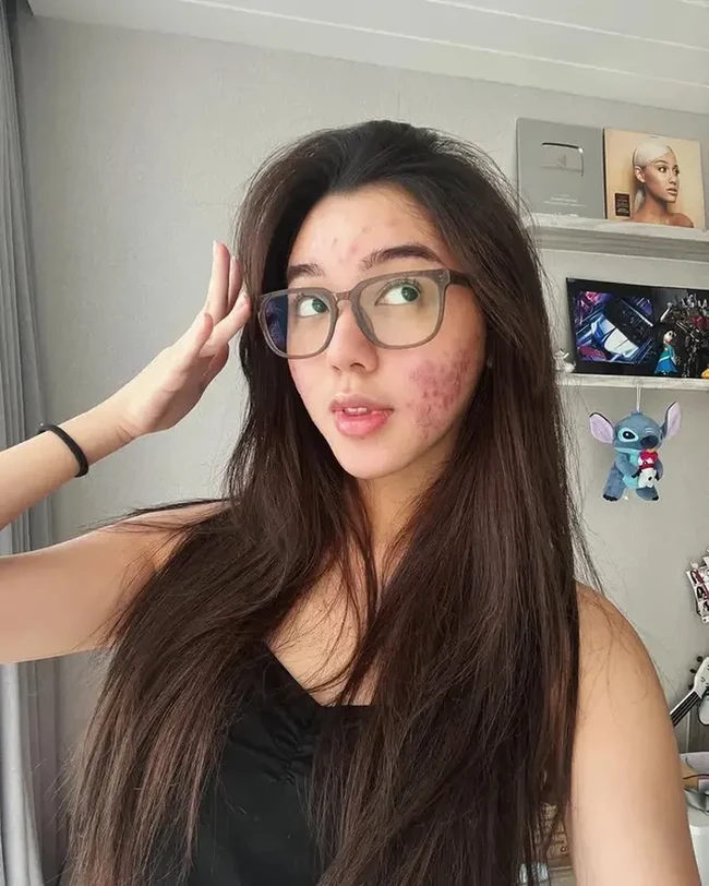 Artis Gabriella Ekaputri sempat jadi sorotan karena keberanian dan kepercayaan dirinya memamerkan wajah aslinya yang dipenuhi jerawat dan kemerahan. Unggahannya itu pun langsung banjir dukungan dari para netizen. Foto: Instagram