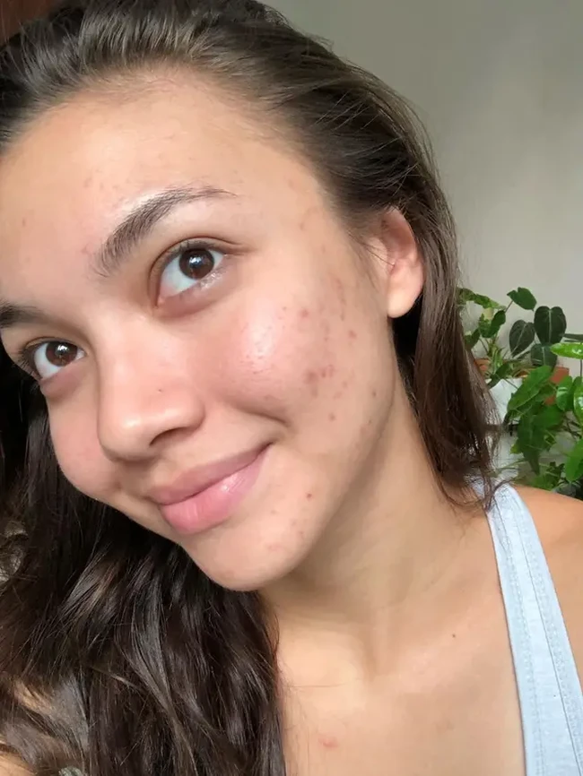 Wajah yang tak mulus juga diperlihatkan oleh Angela Gilsha. Angela mengaku tak malu memamerkan wajah berjerawatnya karena itu adalah sesuatu yang normal dialami manusia. Foto: Instagram