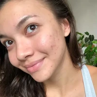 Wajah yang tak mulus juga diperlihatkan oleh Angela Gilsha. Angela mengaku tak malu memamerkan wajah berjerawatnya karena itu adalah sesuatu yang normal dialami manusia. Foto: Instagram