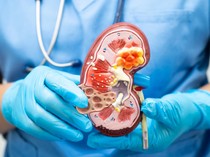 Begini Perubahan Warna Urine yang Menandakan Gagal Ginjal