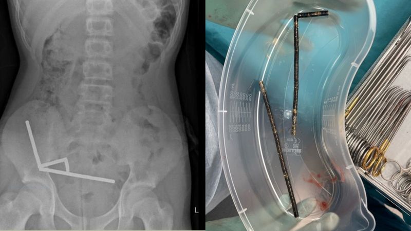 Dokter di Selandia Baru terpaksa mengeluarkan sebagian usus seorang remaja laki-laki berusia 13 tahun. Ini disebabkan adanya 100 magnet yang bersarang di usus.