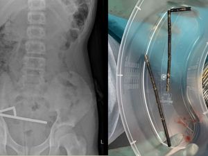 Ngilu! Momen Dokter Keluarkan 100 Magnet dari Usus Remaja 13 Tahun