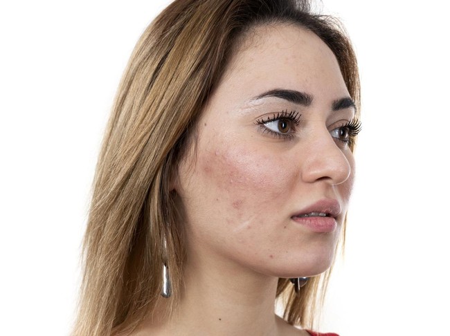 Bekas Jerawat di Wajah