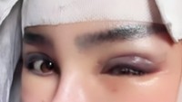 Viral Demi Wajah Runcing Permanen, PNS Lampung Yuni Jasmine Jalani Operasi Viral Demi Wajah Runcing Permanen, PNS Lampung Yuni Jasmine Jalani Operasi