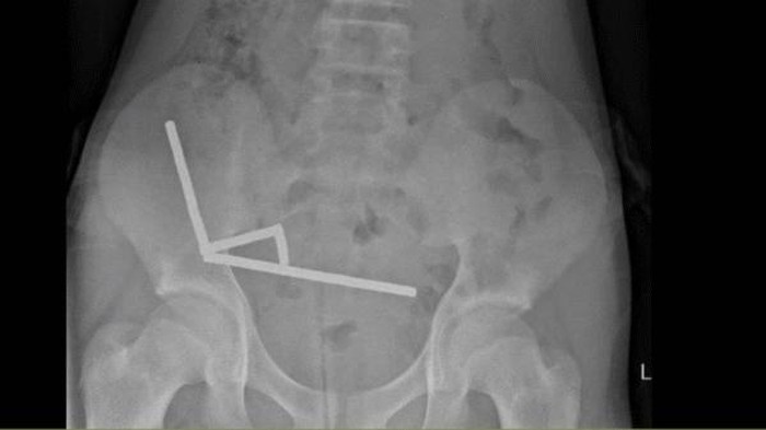 magnet Remaja 13 tahun asal Selandia Baru menelan hampir 200 magnet yang sangat kuat. Akibatnya, dia harus kehilangan sebagian ususnya.