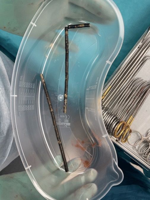 magnet Remaja 13 tahun asal Selandia Baru menelan hampir 200 magnet yang sangat kuat. Akibatnya, dia harus kehilangan sebagian ususnya.