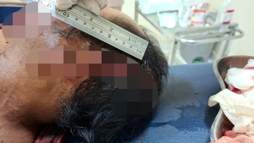 MJ, korban penebasan parang oleh saudara kandung di Lombok Timur, Minggu (26/10/2025). MJ dianiaya akibat sengketa tanah warisan. (Dok. Polres Lombok Timur)