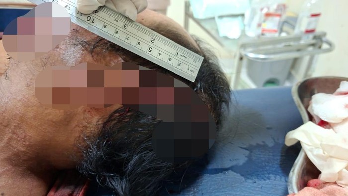 MJ, korban penebasan parang oleh saudara kandung di Lombok Timur, Minggu (26/10/2025). MJ dianiaya akibat sengketa tanah warisan. (Dok. Polres Lombok Timur) MJ, korban penebasan parang oleh saudara kandung di Lombok Timur, Minggu (26/10/2025). MJ dianiaya akibat sengketa tanah warisan. (Dok. Polres Lombok Timur)