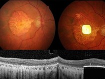 Temuan Chip Mata Kecil oleh Ilmuwan Stanford, Bisa Bantu Orang Buta Melihat