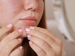 Pakai Sunscreen Jadi Bikin Breakout? Begini Cari Produk Sesuai Tipe Kulit