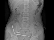 Penampakan Ngeri Usus Anak 13 Tahun usai Telan 100 Magnet, Berakhir Dioperasi