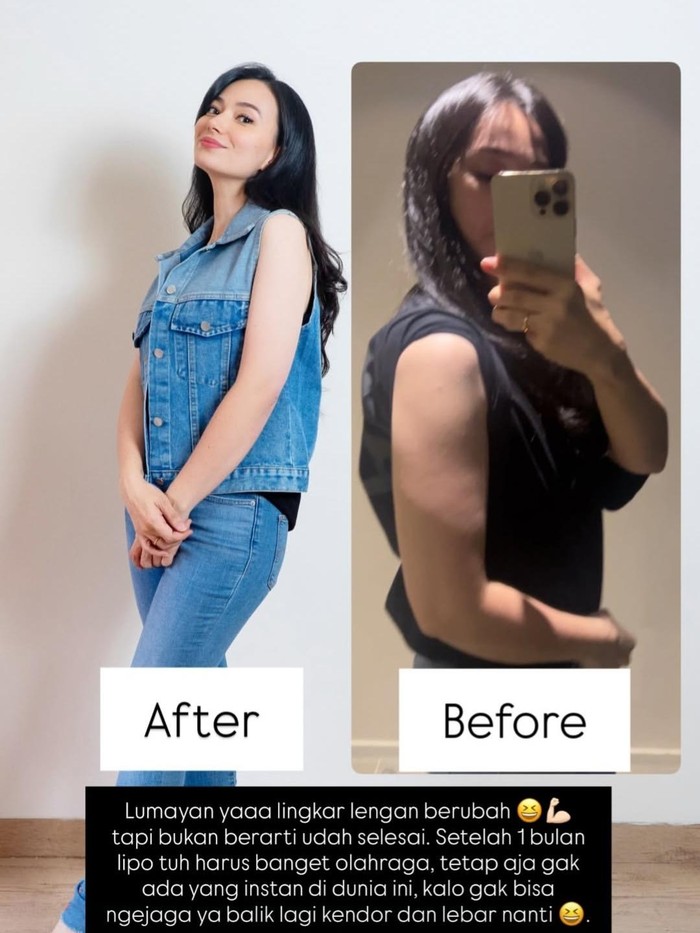 Asmirandah pilih melakukan liposuction atau sedot lemak untuk kecilkan lingkar paha dan lengan.