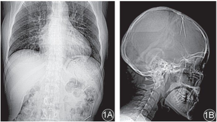 Jarum besi dalam tubuh manusia.