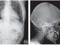 Foto Rontgen Ini Ungkap Temuan Jarum Misterius di Tubuh Pasien, Masuk Lewat Mana?