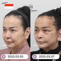 Jennifer menjalani facelift untuk membuat kulitnya lebih kencang dan muda. Dalam foto terlihat wajah Jennifer sebelum dan setelah tindakan. Foto: Instagram/@ajunperwira/@jennifer_ipel/@ab_plasticsurgery_idn