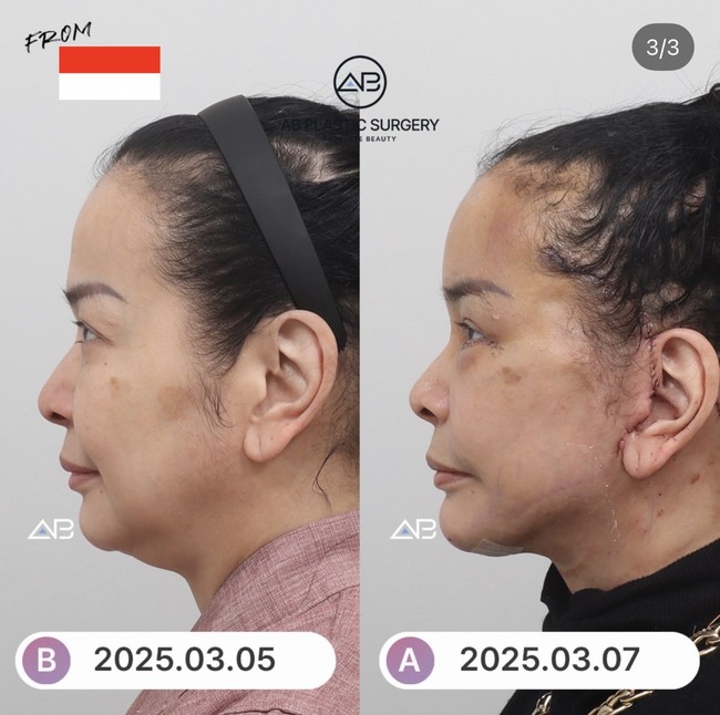 Dilihat dari samping tampak jelas wajah Jennifer jadi semakin tirus dan lifting meski masih lebam dan bekas jahitan pun tampak jelas di bagian samping wajahnya. Foto: Instagram/@ajunperwira/@jennifer_ipel/@ab_plasticsurgery_idn