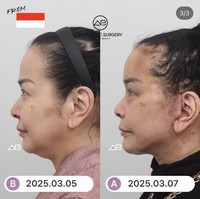 Dilihat dari samping tampak jelas wajah Jennifer jadi semakin tirus dan lifting meski masih lebam dan bekas jahitan pun tampak jelas di bagian samping wajahnya. Foto: Instagram/@ajunperwira/@jennifer_ipel/@ab_plasticsurgery_idn