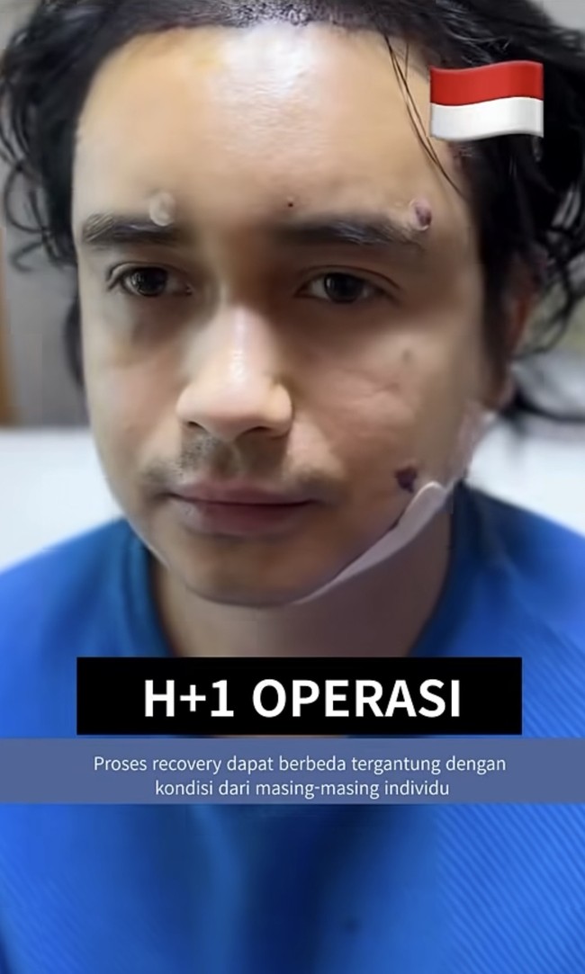 Sementara Ajun menjalani double chin liposuction dan tanam rambut. Begini potretnya setelah tindakan. Hampir sama dengan sang istri, wajah Ajun pun terlihat masih bengkak. Foto: Instagram/@ajunperwira/@jennifer_ipel/@ab_plasticsurgery_idn