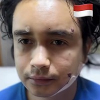 Sementara Ajun menjalani double chin liposuction dan tanam rambut. Begini potretnya setelah tindakan. Hampir sama dengan sang istri, wajah Ajun pun terlihat masih bengkak. Foto: Instagram/@ajunperwira/@jennifer_ipel/@ab_plasticsurgery_idn