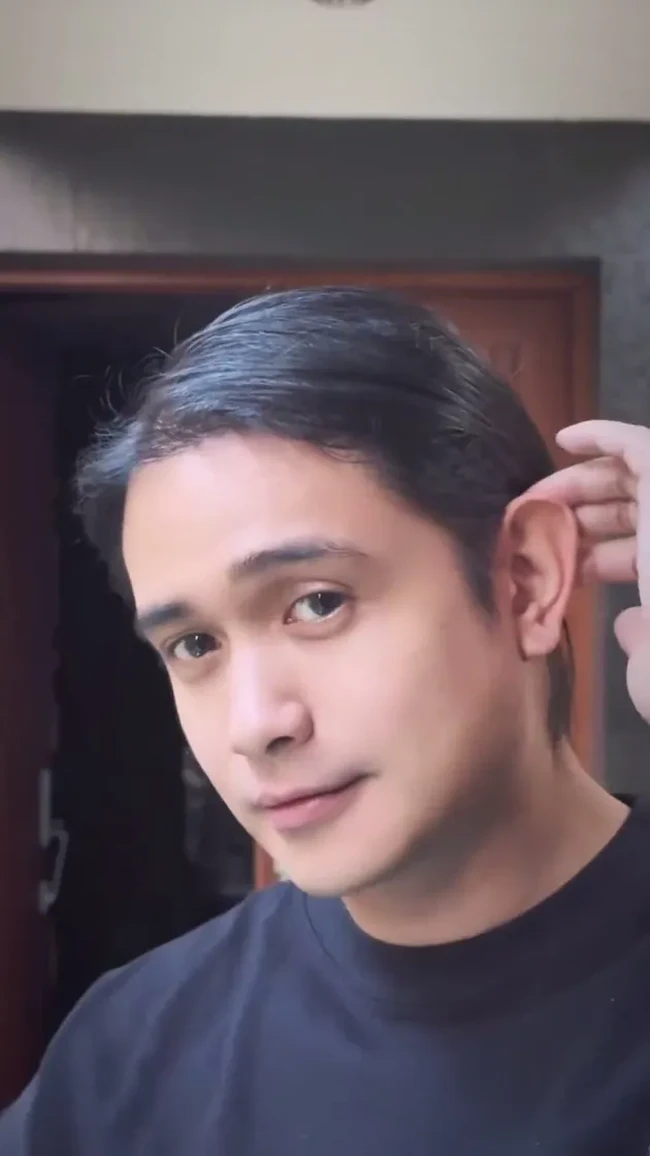 Double chin di dagunya pun tampak sirna. Kini penampilannya jadi terlihat semakin fresh. Foto: Instagram/@ajunperwira/@jennifer_ipel/@ab_plasticsurgery_idn