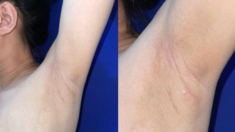 Punya 'Puting' Tambahan, Wanita Ini Keluarkan ASI dari Ketiaknya