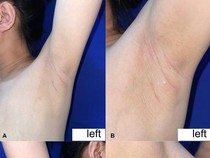 Punya Puting Tambahan, Wanita Ini Keluarkan ASI dari Ketiaknya