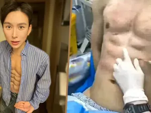 Demi Sixpack, Pria Habiskan Rp 9,3 M Suntik Hyaluronic Acid, Ini Hasilnya