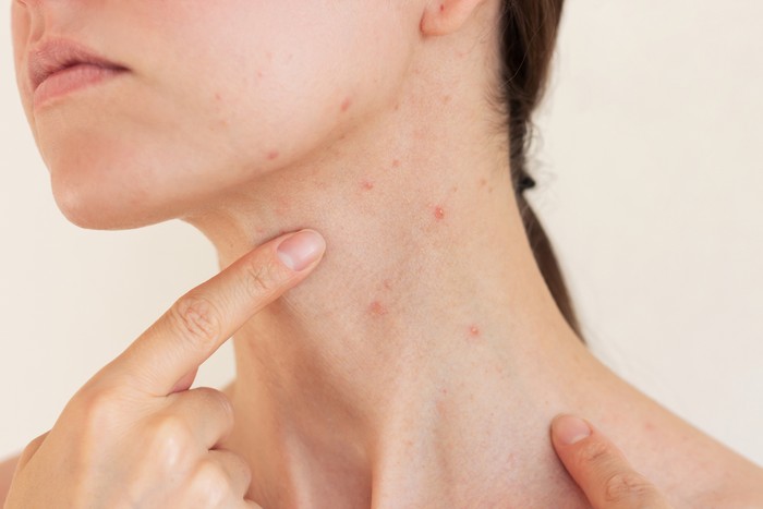 Jerawat di Leher