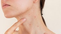Kenapa Jerawat Muncul di Leher? Ini Penyebab dan Cara Menghilangkannya