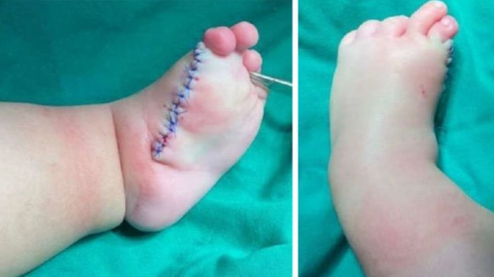 Penemuan bocah jari kaki kiri 10.