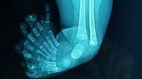 Bayi berusia tiga bulan itu diketahui memiliki struktur tulang kaki yang ikut bertambah, termasuk sembilan metatarsal. Hasil radiologi menunjukkan seluruh tulang jari terbentuk sempurna dan berfungsi seperti jari normal. (Foto: Journal of International Surgery and Clinical Medicine (JISCM))