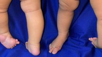 Bayi tersebut menjalani operasi untuk memperbaiki bentuk kaki dan mendukung fungsi geraknya di masa depan. Tindakan ini juga membantu proses terapi kaki pengkor yang membutuhkan koreksi bertahap. (Foto: Journal of International Surgery and Clinical Medicine (JISCM))